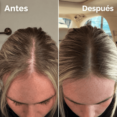VALENTIA™| Sérum Capilar PDRN con Microagujas