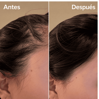 VALENITA™| Sérum Capilar PDRN con Microagujas